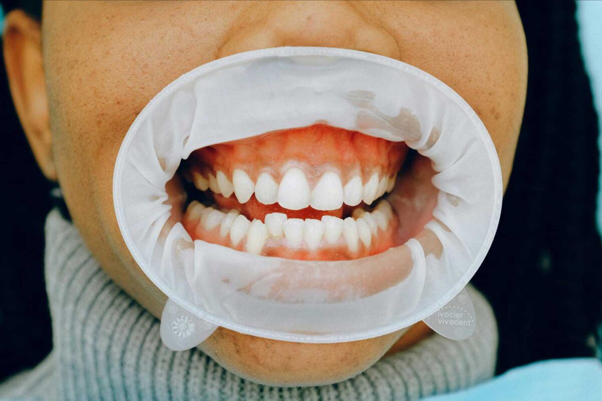 Maintaining Healthy Gums
